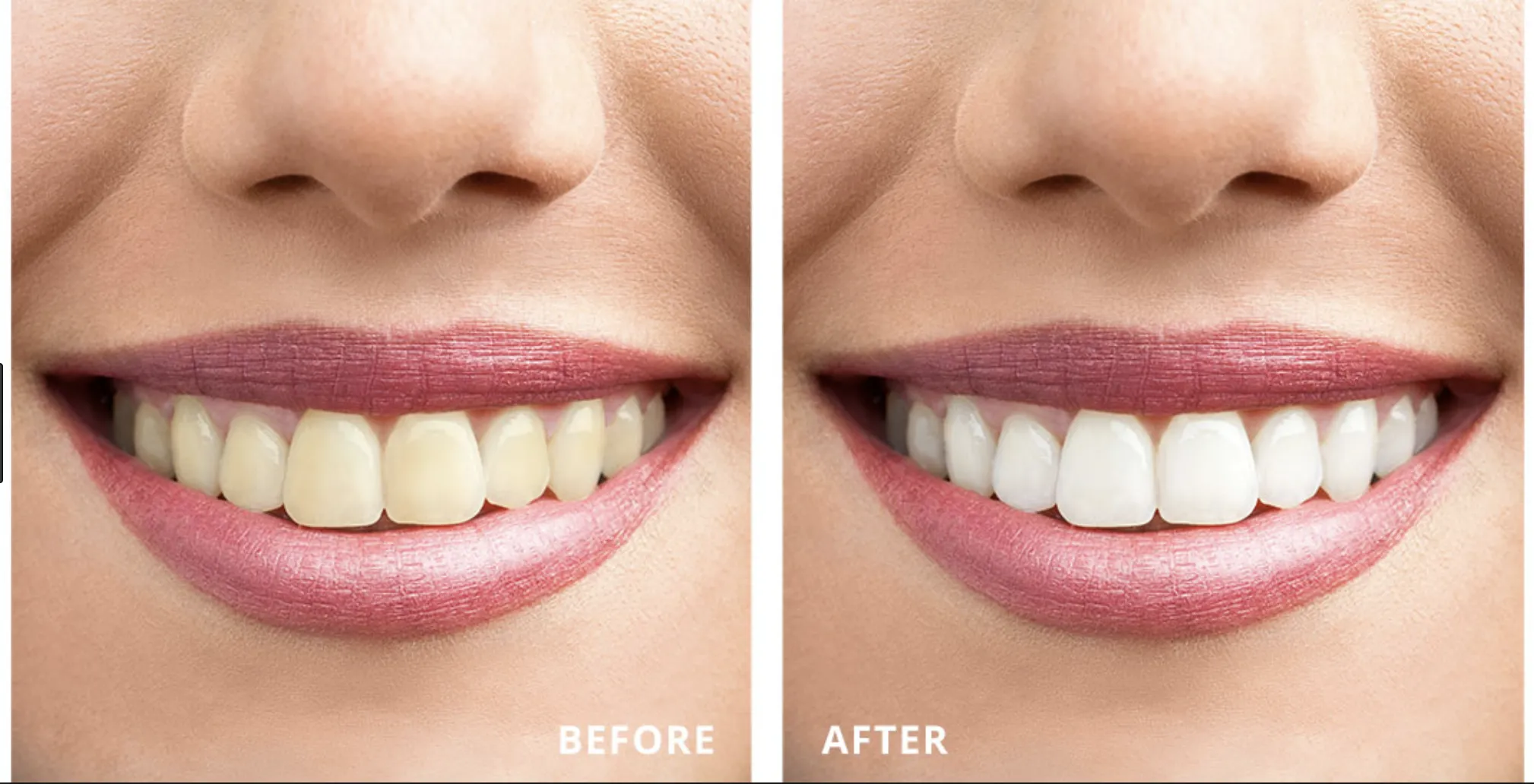 33915 plymouth teeth whitening smile