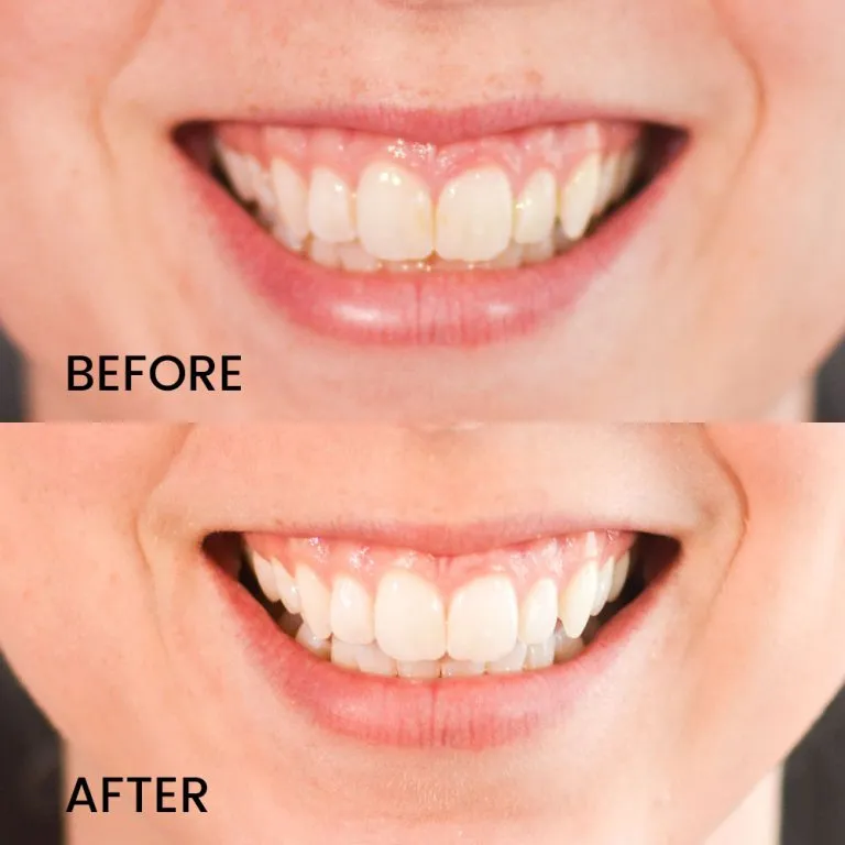 33916 teeth sensitivity