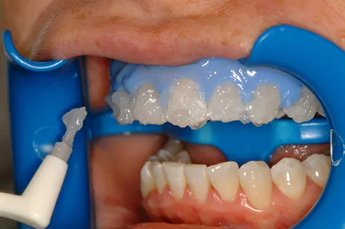 33918 lumibrite teeth whitening cost image5