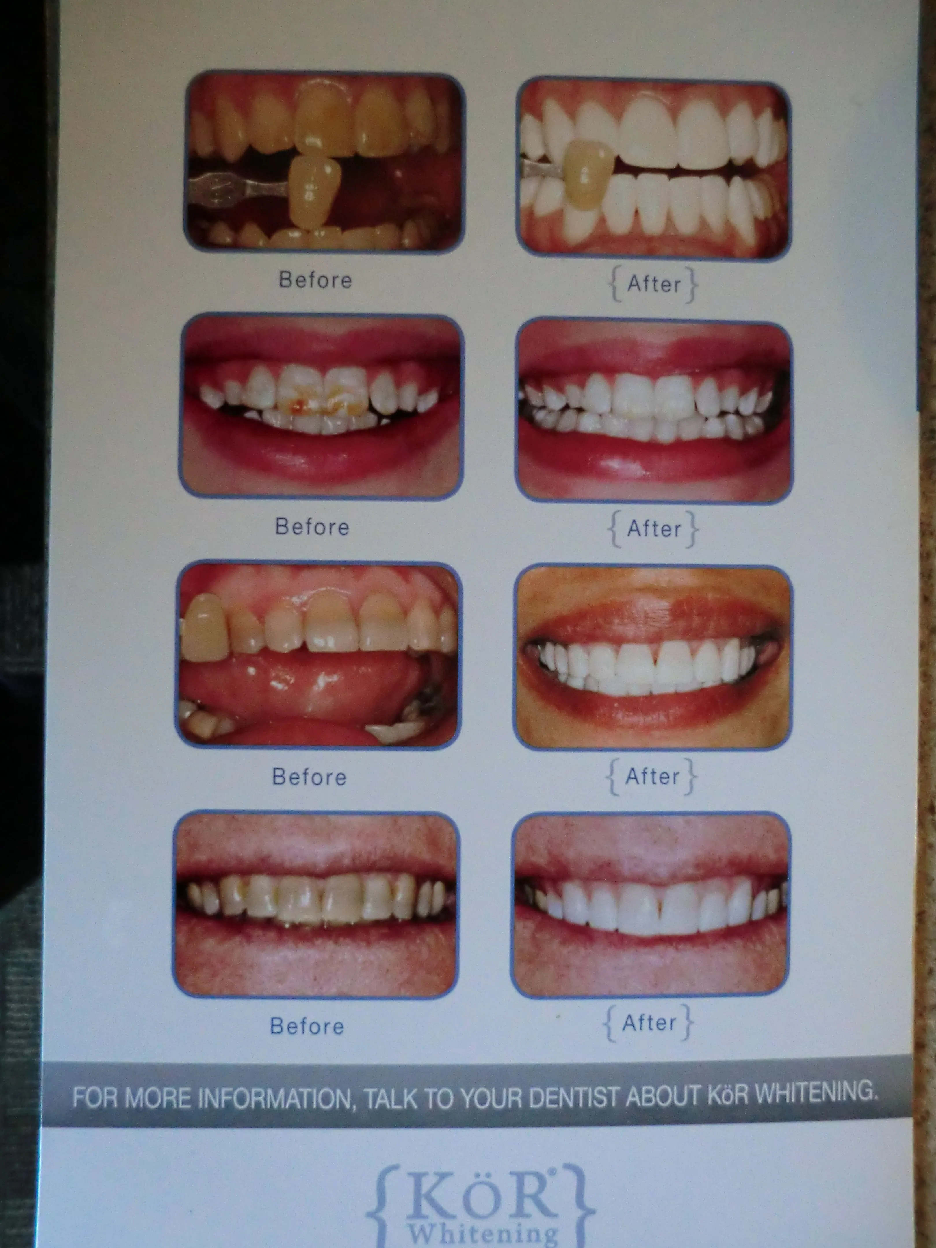 33918 lumibrite teeth whitening results image3