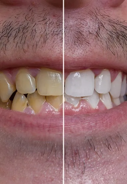 33920 sapphire teeth whitening cost