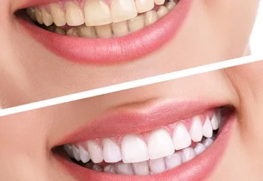 33920 sapphire teeth whitening diet