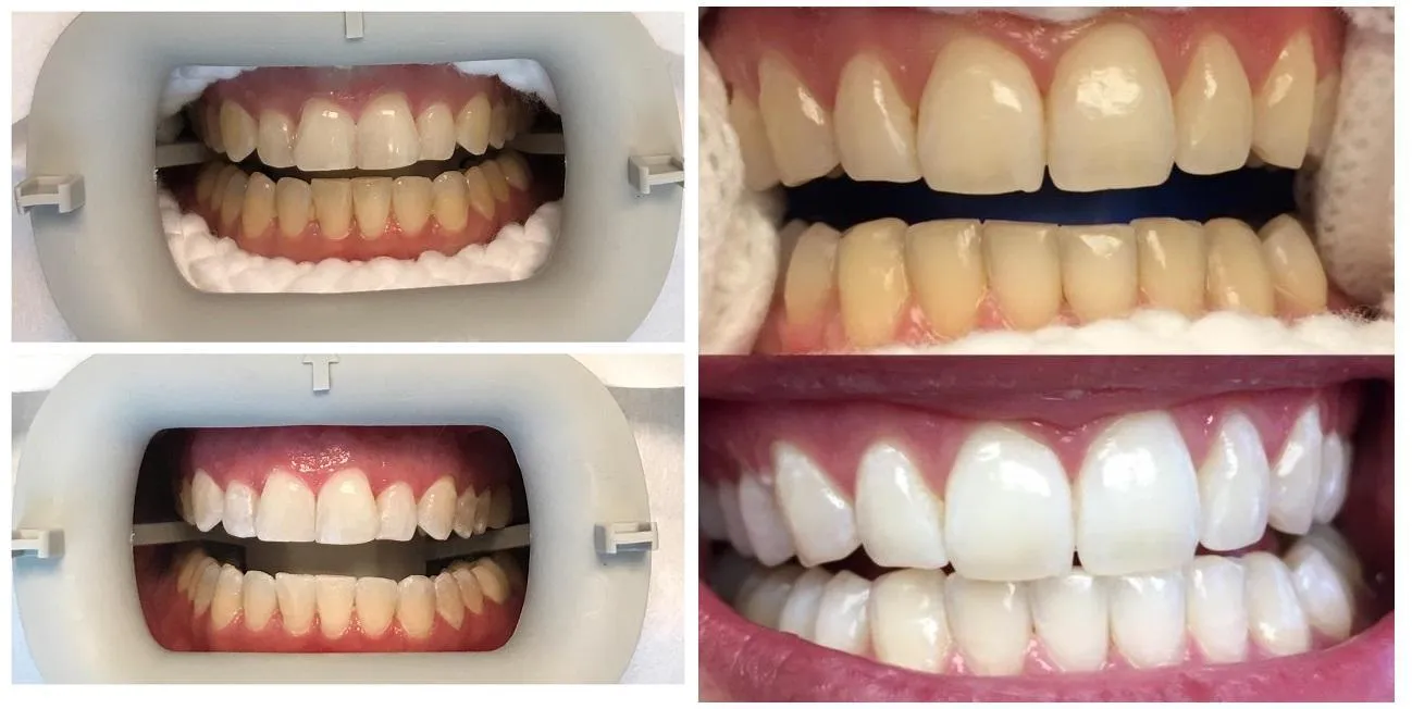 33924 teeth whitening options