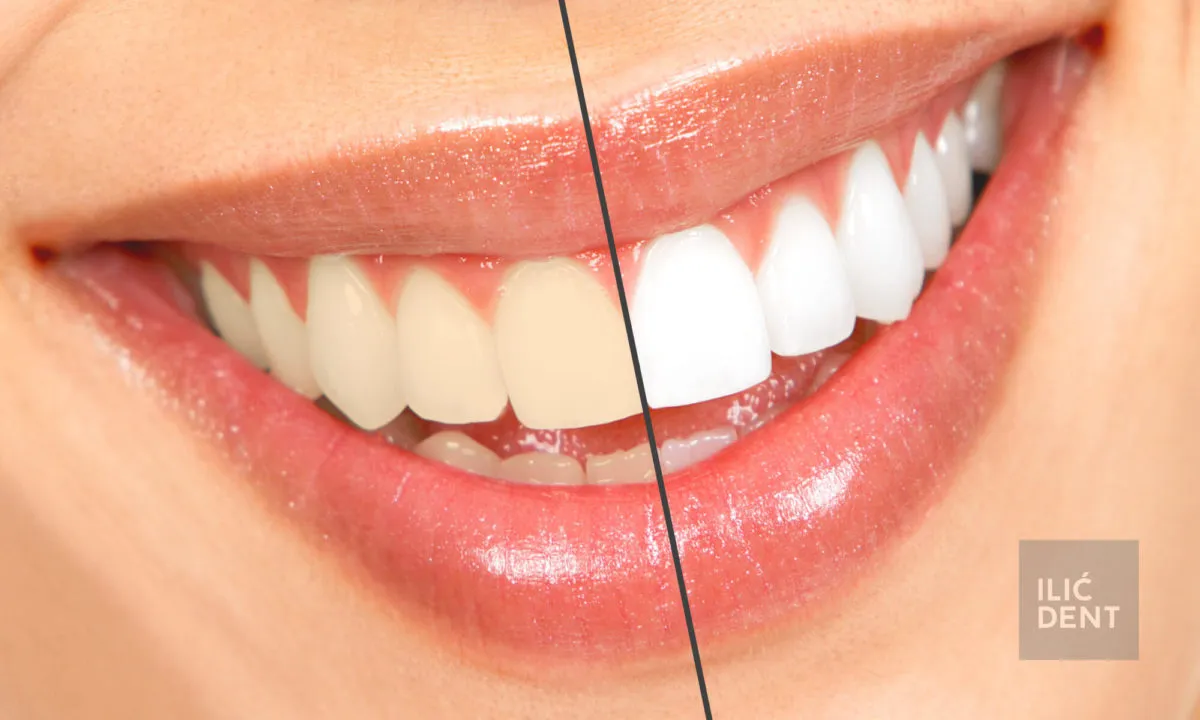 33927 maintaining white teeth