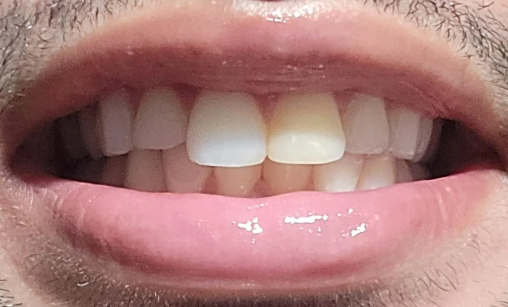 33929 best teeth whitening product