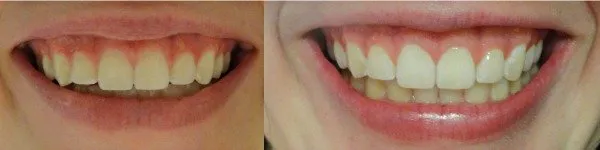 33933 charcoal teeth whitening 5