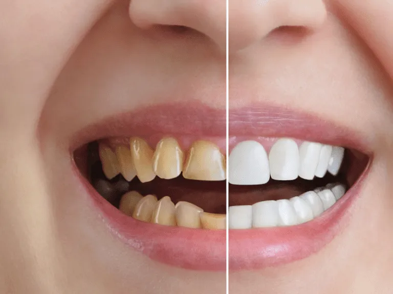 33934 at home teeth whitening