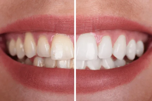 33934 professional teeth whitening