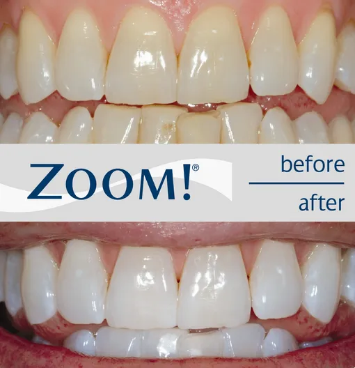 33937 in office teeth whitening