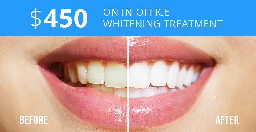 33937 professional teeth whitening