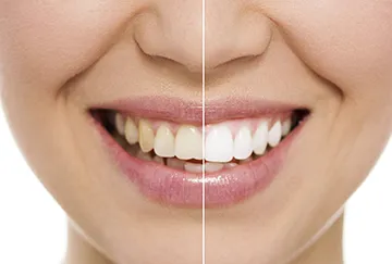 33938 take home whitening kit