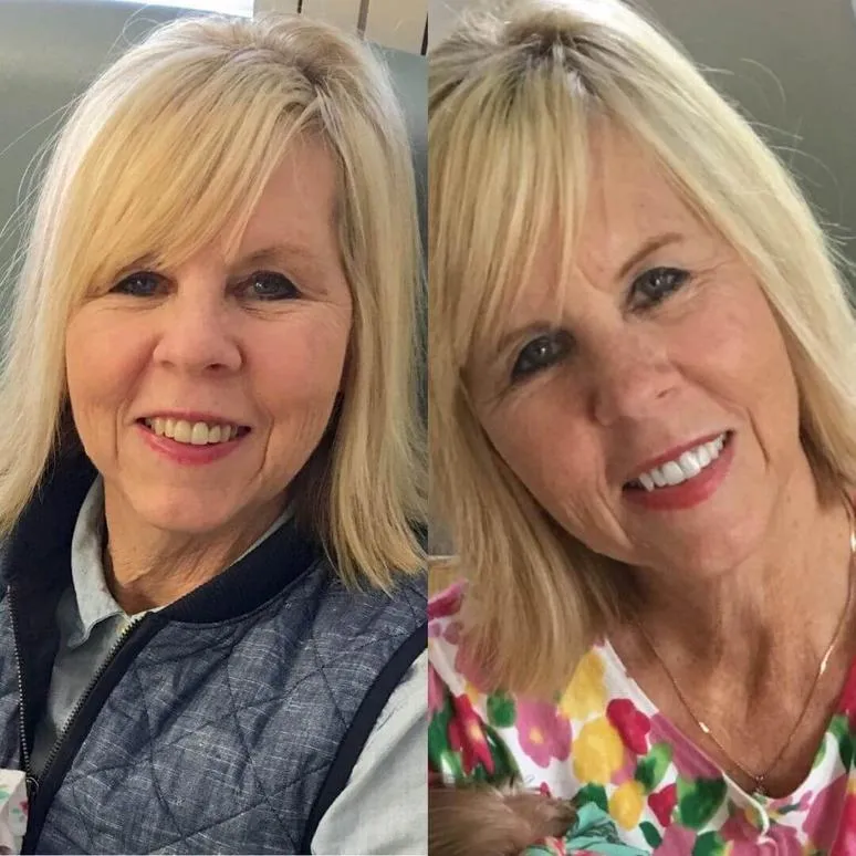 33940 teeth whitening process