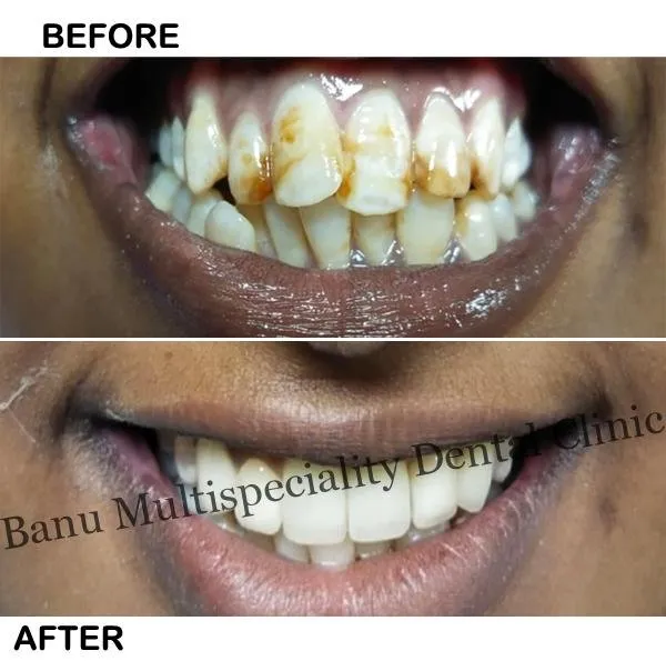 33945 professional teeth whitening