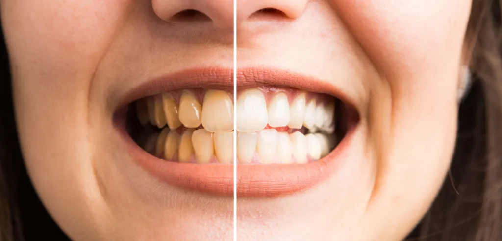/img/33948-teeth-whitening-hereford-athome.webp