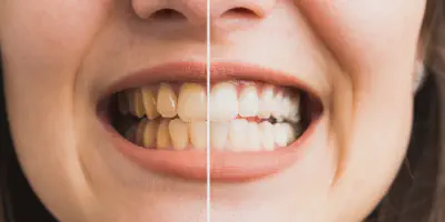 /img/33948-teeth-whitening-hereford-athome.webp