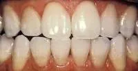 33948 teeth whitening hereford cost