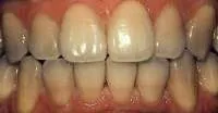 33948 teeth whitening hereford oral health