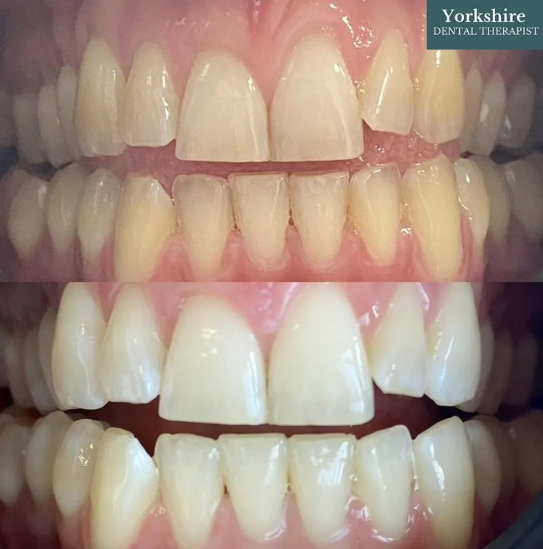 33948 teeth whitening hereford professional