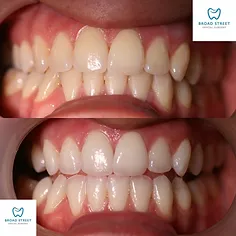 33948 teeth whitening hereford smile