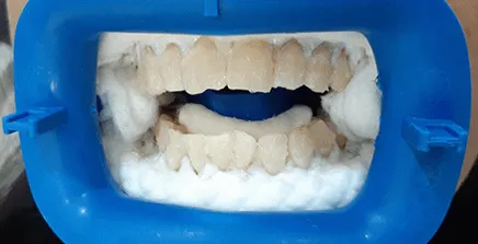 33949 at home teeth whitening ga