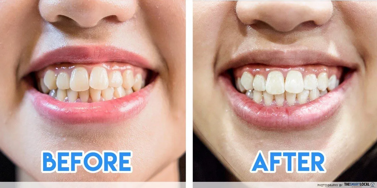 33957 arc teeth whitening products