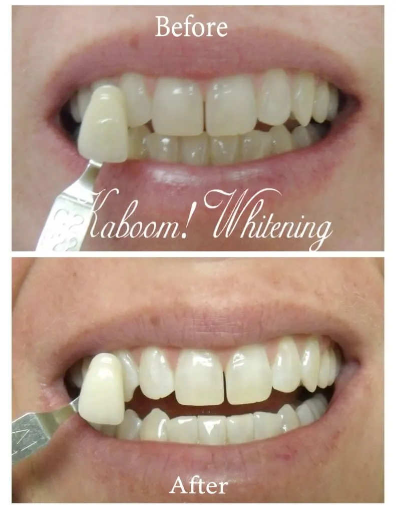 /img/33957-professional-teeth-whitening.webp