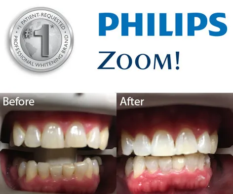 33957 teeth whitening sensitivity