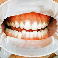 33960 allergic reaction teeth whitening