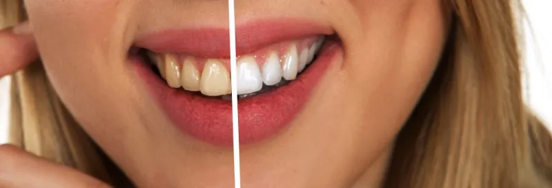 33960 improper whitening application
