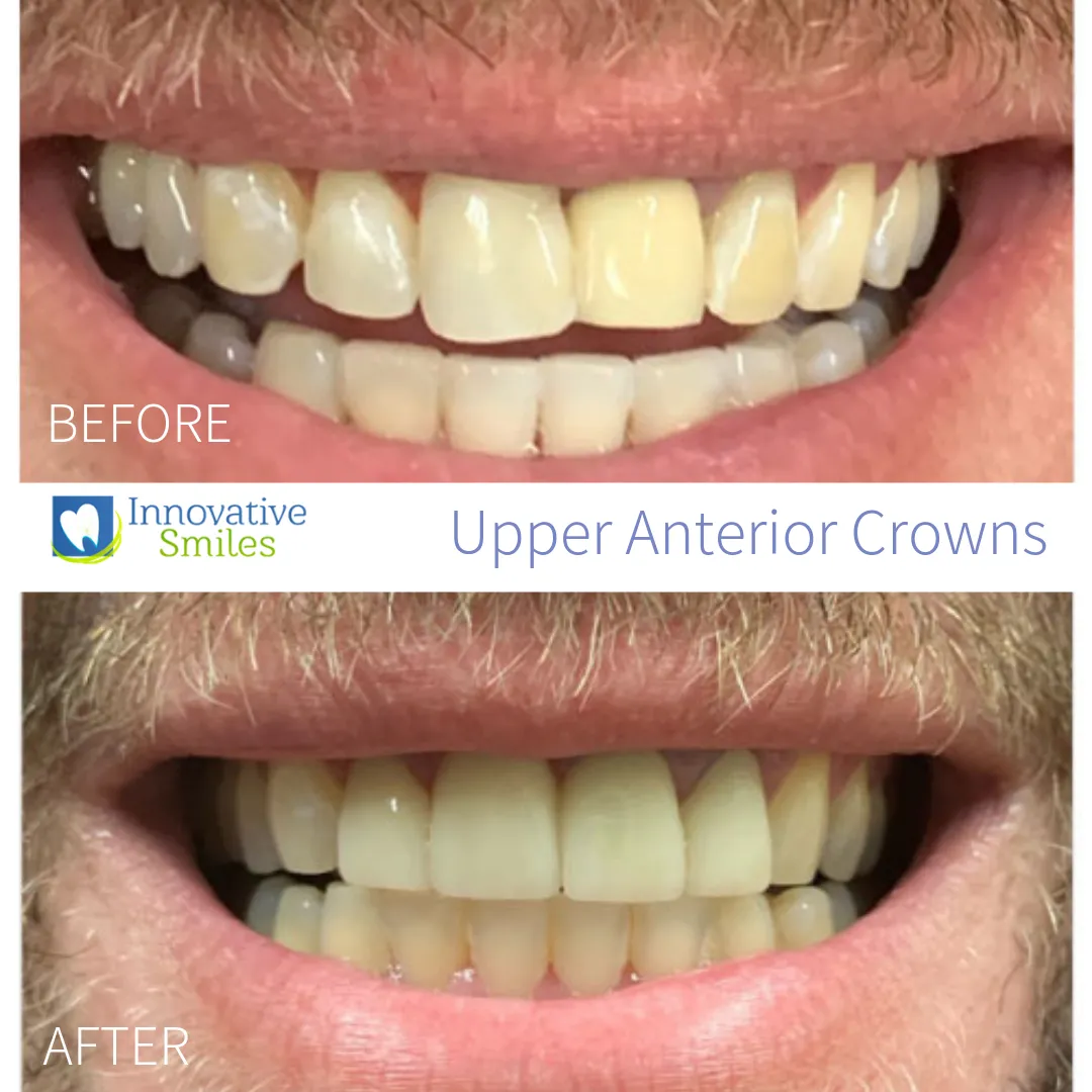 33966 zirconia crowns