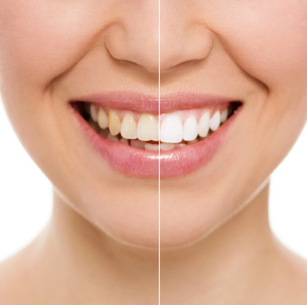 /img/33972-choosing-teeth-whitening.webp