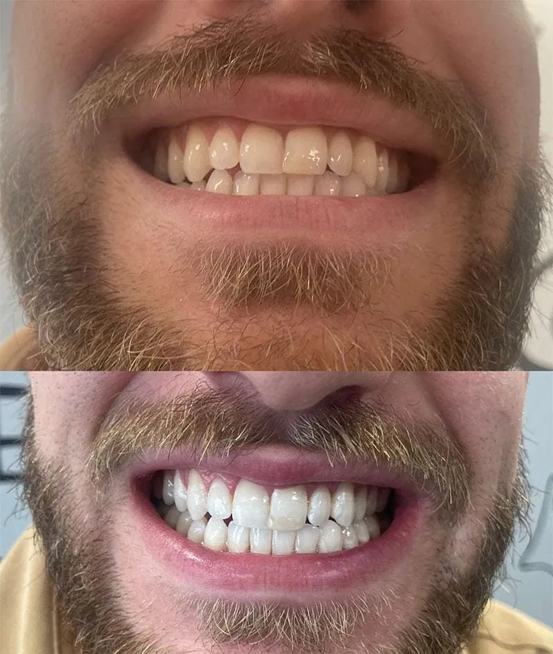 33972 teeth whitening comparison