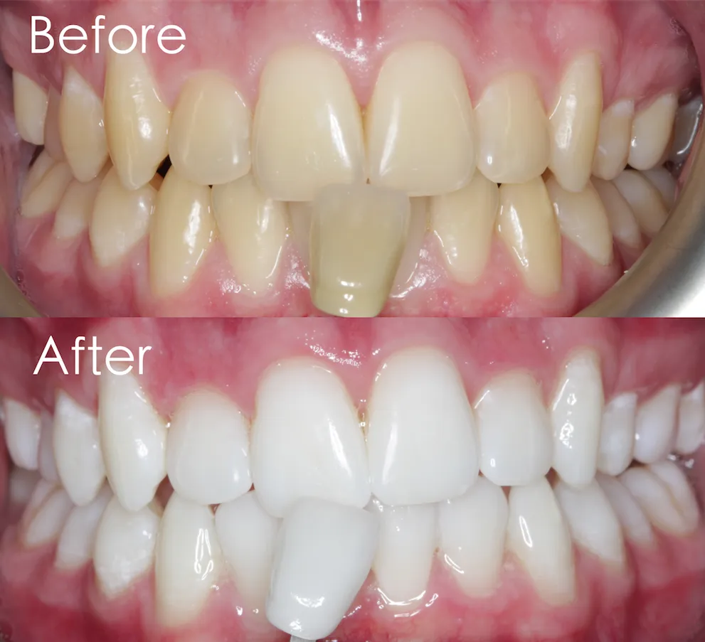 33972 teeth whitening options