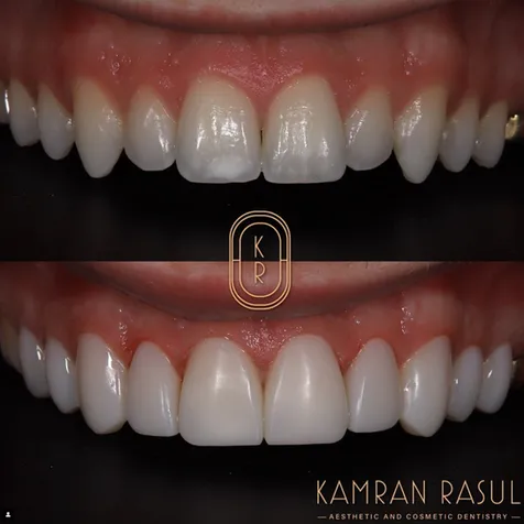 33974 in office teeth whitening