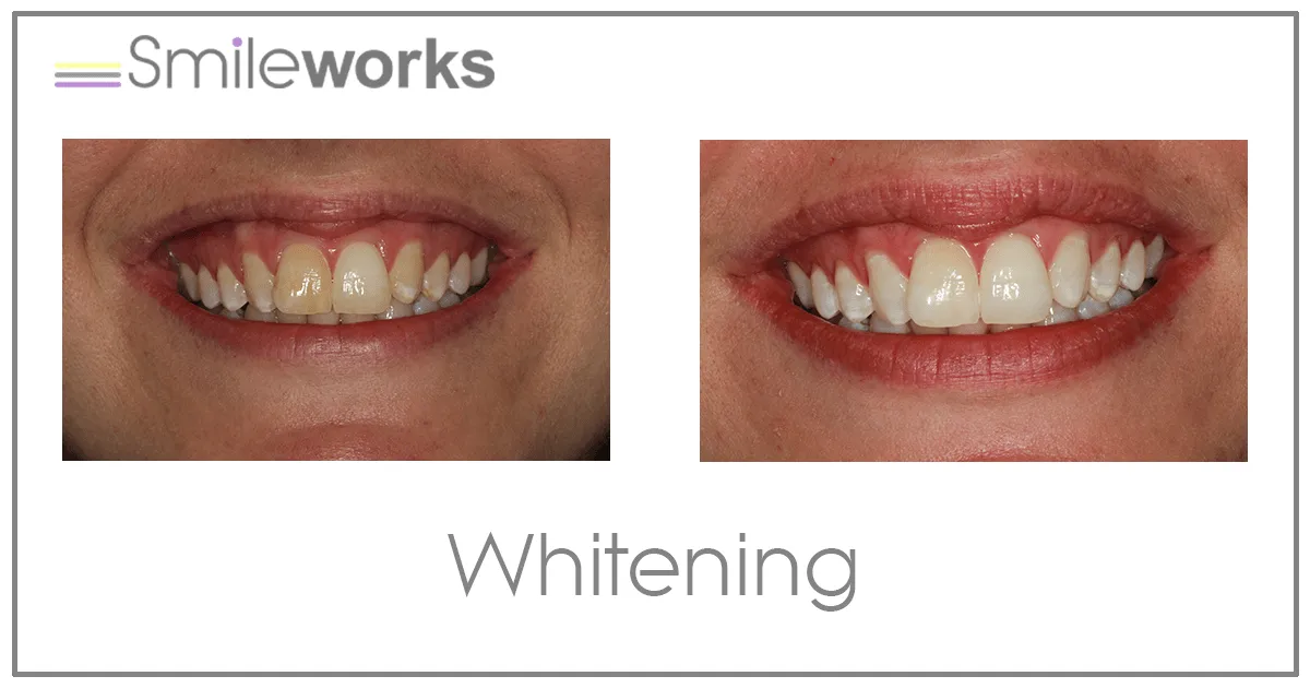 33974 over the counter teeth whitening