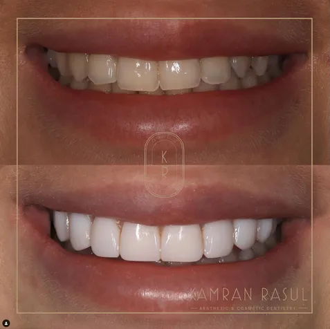 33974 professional teeth whitening