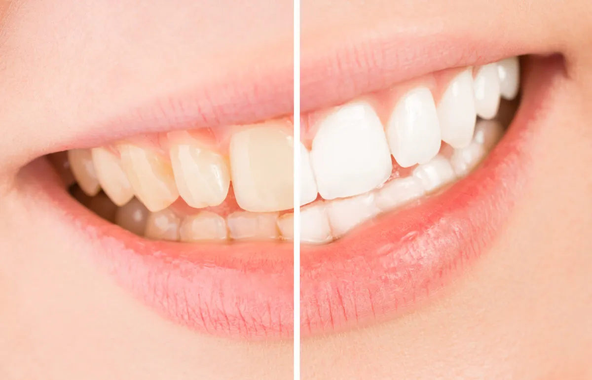 33979 teeth whitening treatment