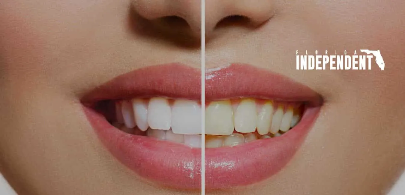 33979 types of teeth whitening