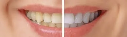 33987 teeth whitening scottsdale arizona 4