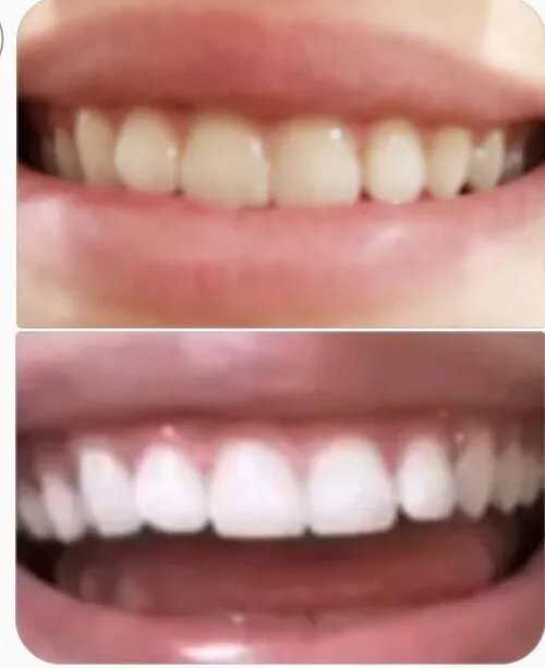 33987 teeth whitening scottsdale arizona 6