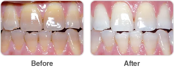 33992 teeth whitening comparison