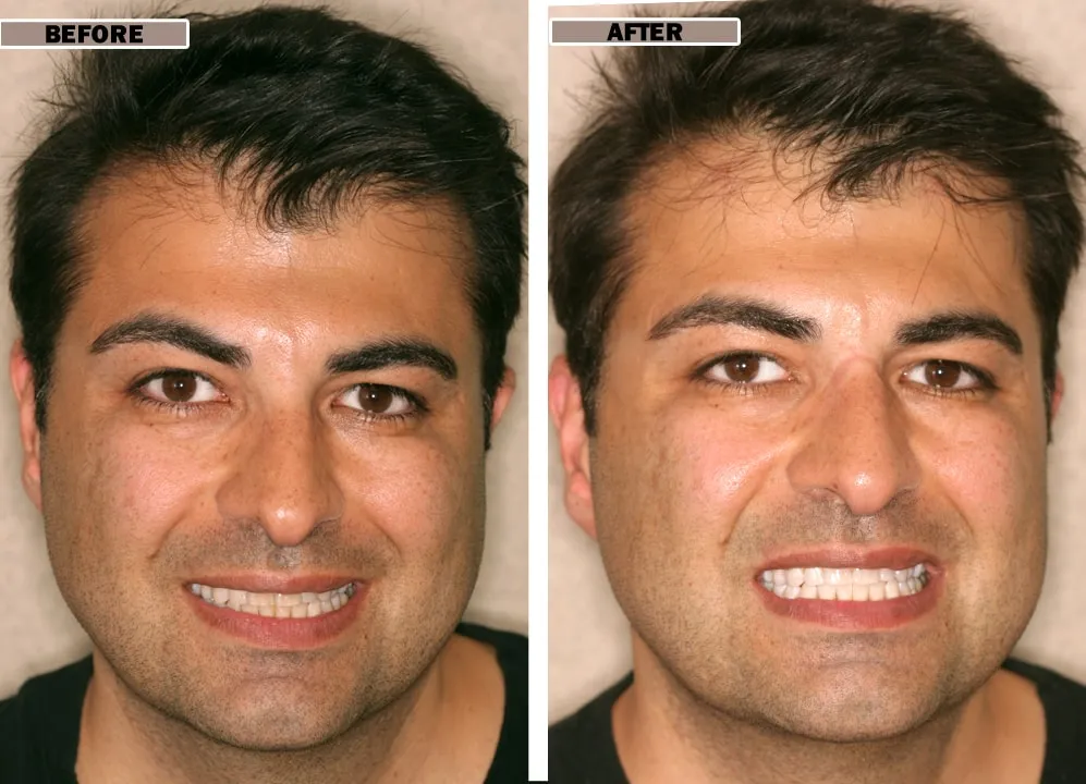 33999 nu smile teeth whitening foods to avoid