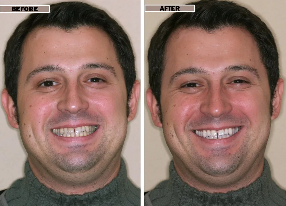 33999 nu smile teeth whitening gel application