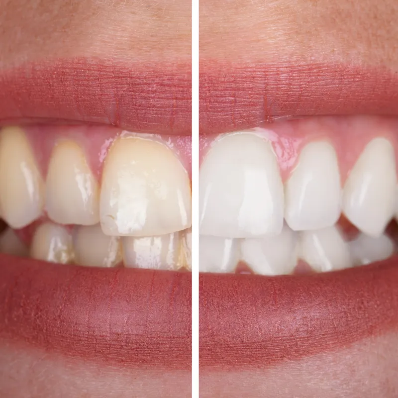 34004 professional teeth whitening