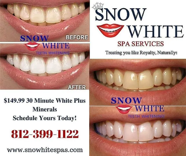 34008 teeth whitening gma image5