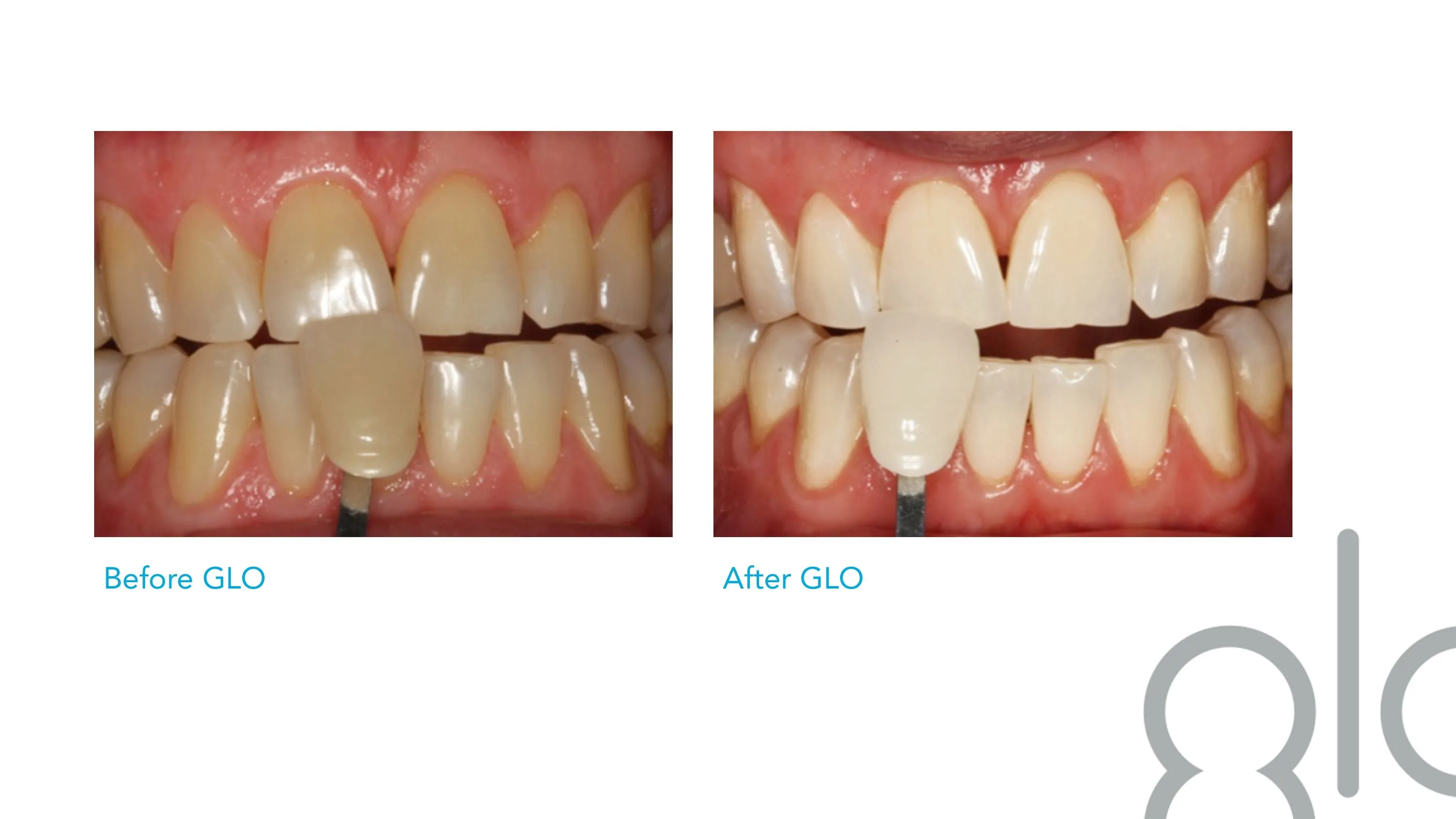 34008 teeth whitening gma image6