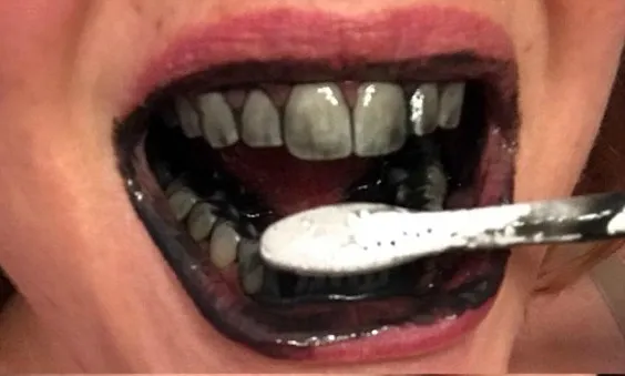 /img/34016-teeth-whitening-diet.webp