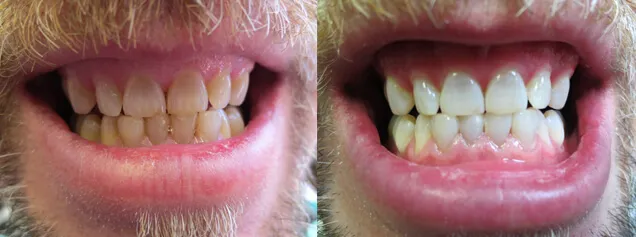 34020 zoom whitening manchester smile