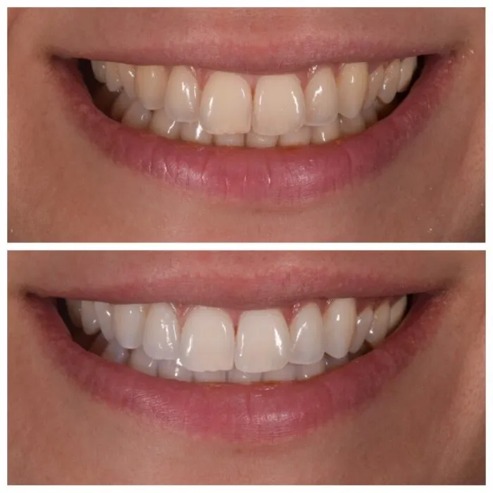 34021 teeth whitening gel