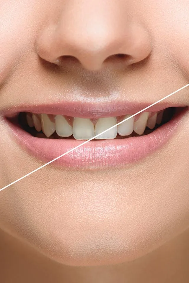 34026 teeth whitening results